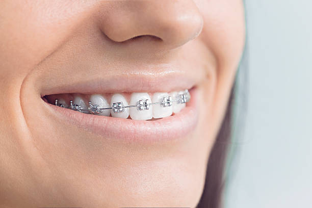 Best Wisdom Tooth Removal  in Duson, LA